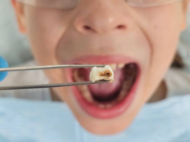 Best Walk-In Emergency Dentist in Brookfield, MO